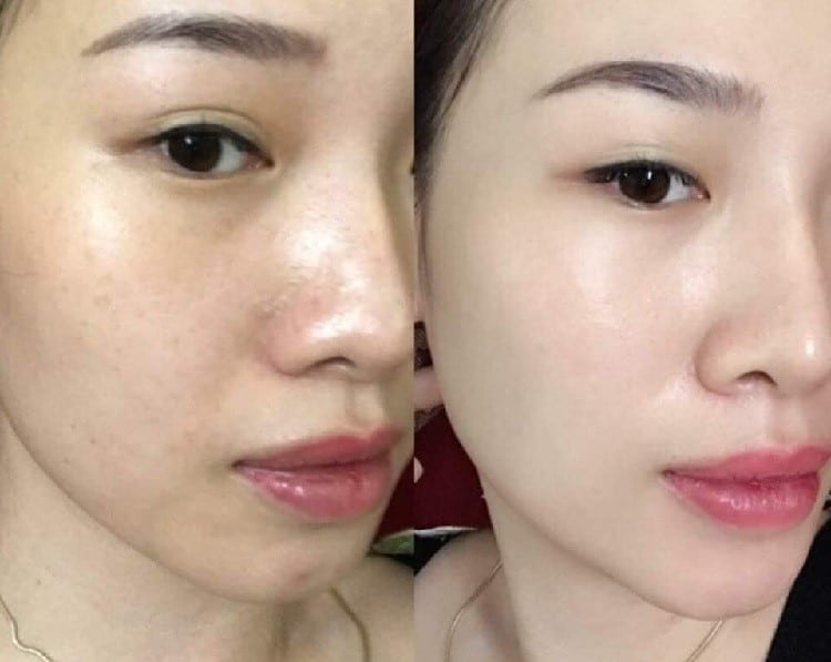 Sự thay đổi khi dùng kem chống nắng trị đốm nâu Martiderm DSP Despigmenting Cream Facial SPF 50+