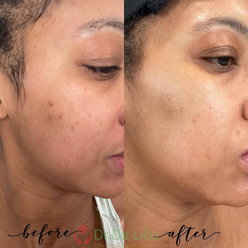 ILUMA Intense Facial Illuminator review
