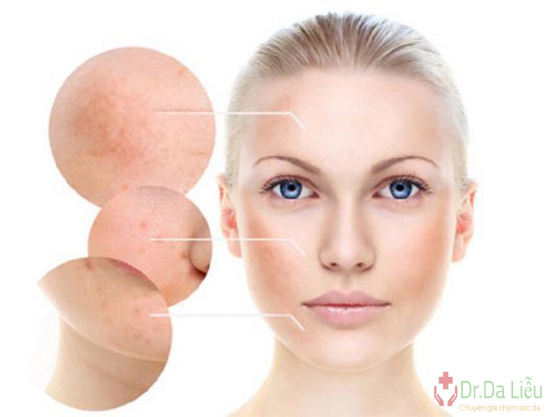 Vi Derm Beauty Hydroquinone 4 giúp giảm thâm nám và đều màu da hiệu quả