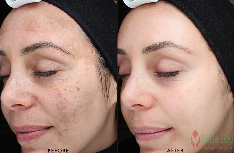 ViDerm Hydroquinone 2%
