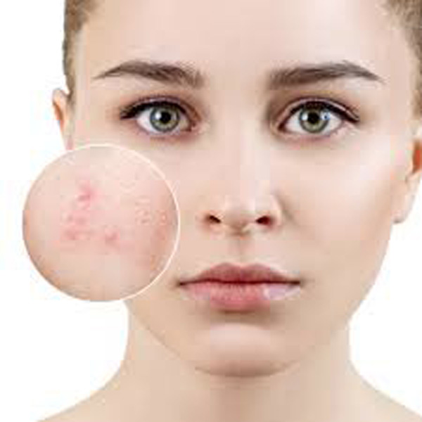 Tretinoin trị mụn