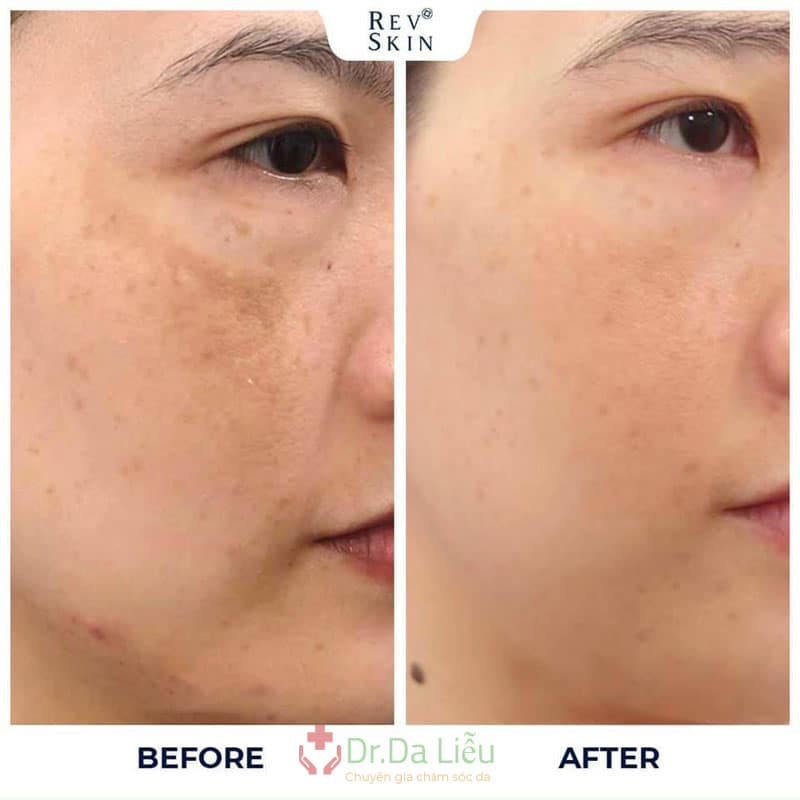 RevSkin Trilasma Fade Melasma, PIH