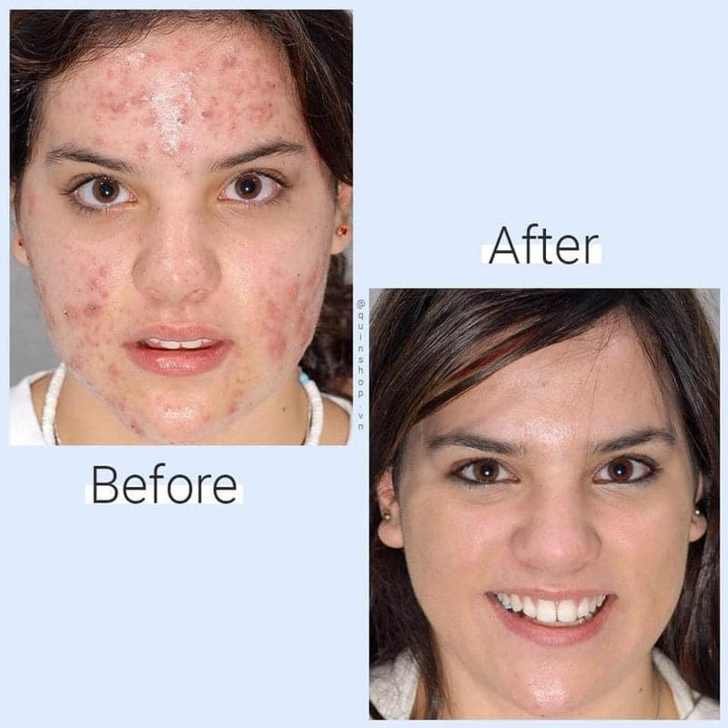 obagi tretinoin gel 0.05 reviews