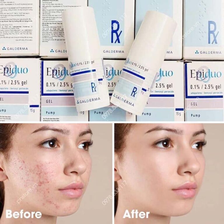 Epiduo giá bao nhiêu Epiduo Gel trị mụn có tốt không Dr.Da liễu của bạn