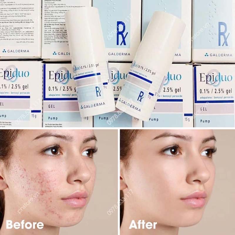 epiduo gel có tốt không