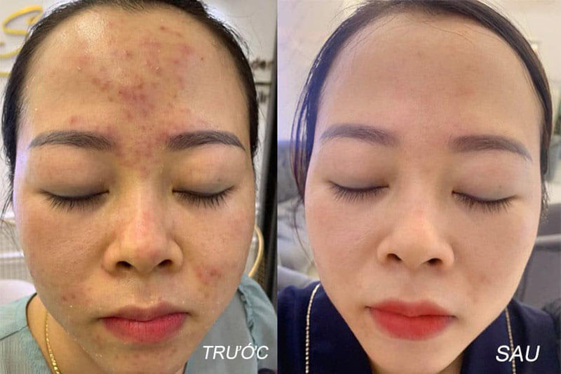 epiduo gel