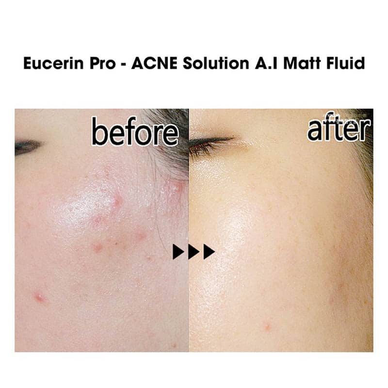 eucerin pro acne solution ai matt fluid