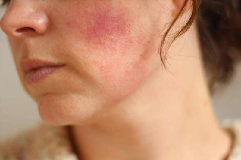 Da nhiễm corticoid