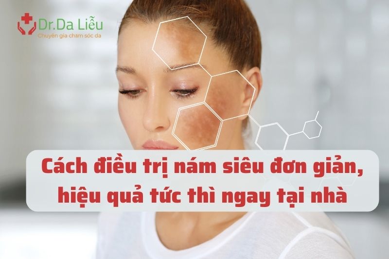 Cách điều trị nám siêu đơn giản
