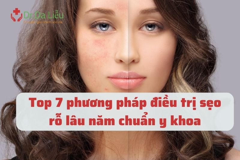 Một số phương pháp điều trị sẹo rỗ phổ biến nhất 2023