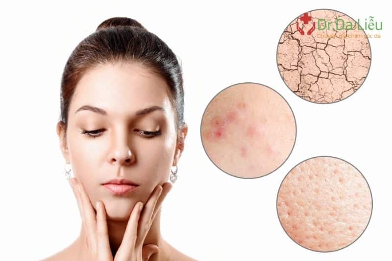 Các nguyên nhân gây nổi mụn?