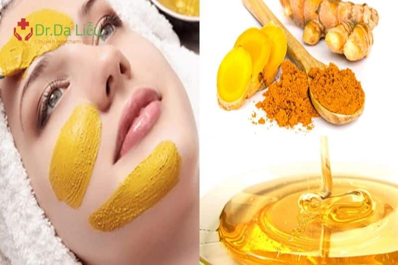Mặt nạ nghệ + mật ong - trị mụn sâu