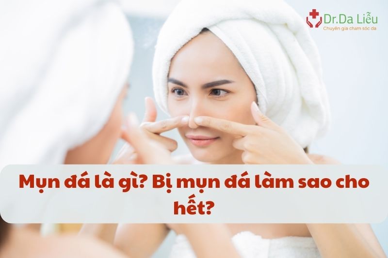 Mụn đá là gì? Bị mụn đá làm sao cho hết? - Giải đáp từ chuyên gia