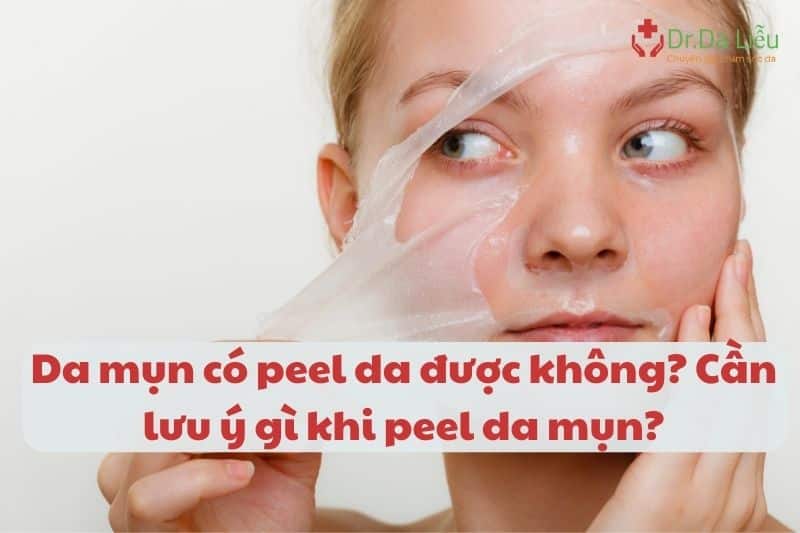 Da mụn có peel da được không?